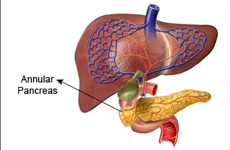 Annular Pancreas