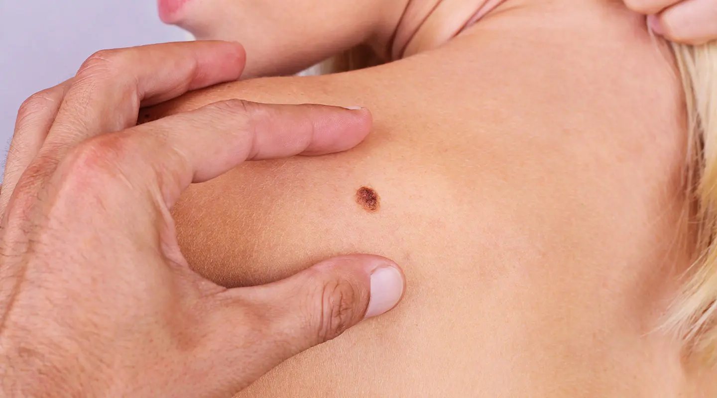 How to Spot Skin Cancer - After you do skin cancer check online booking