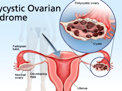 pcos and infertility